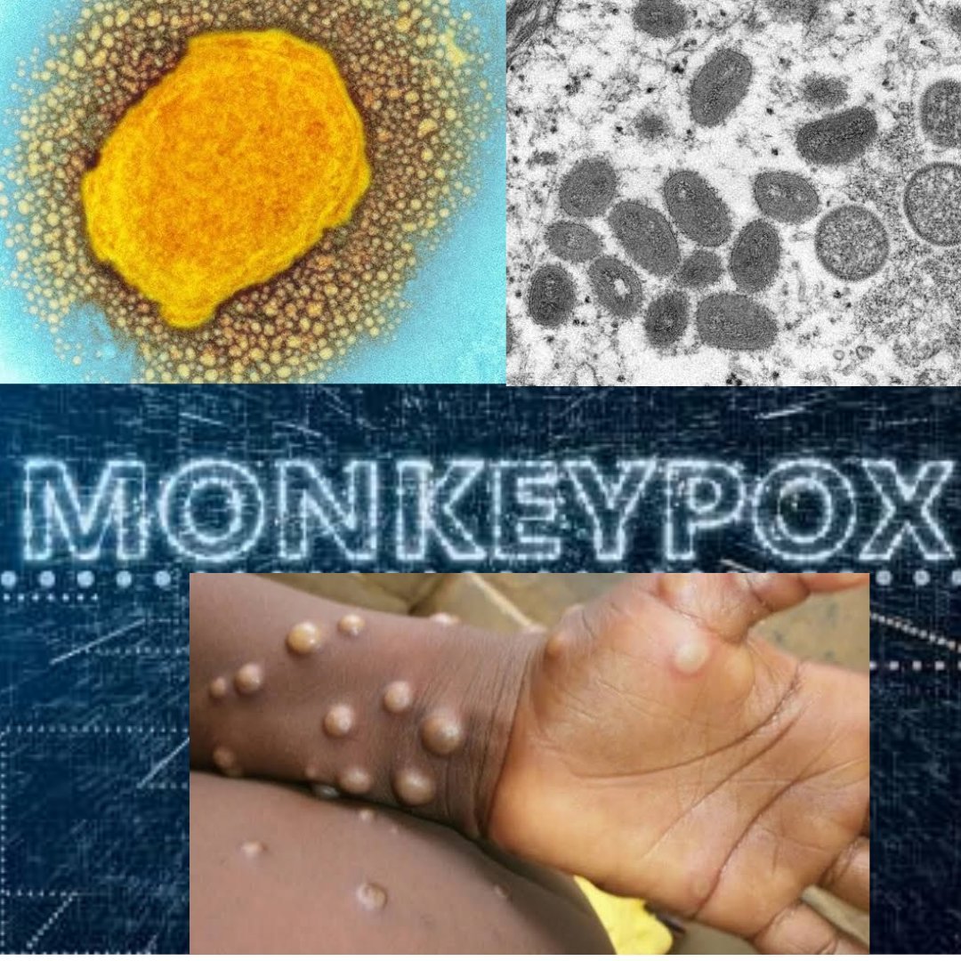 Homoeopathic management for monkeypox virus